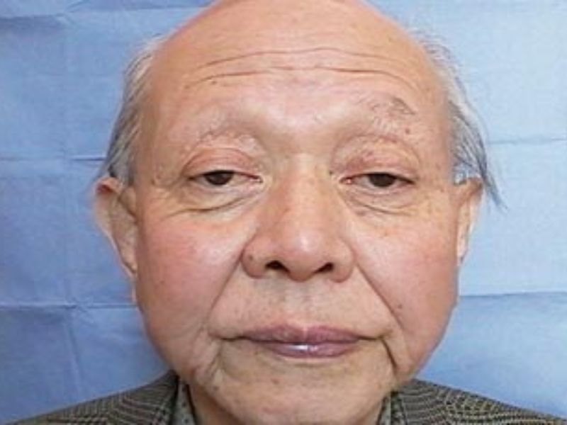 CS眼科-眼瞼下治療